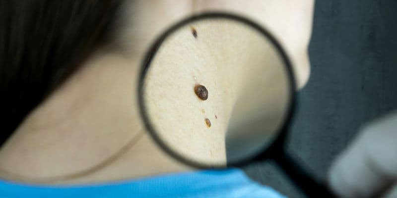 El cáncer de piel es el más común en Países Bajos